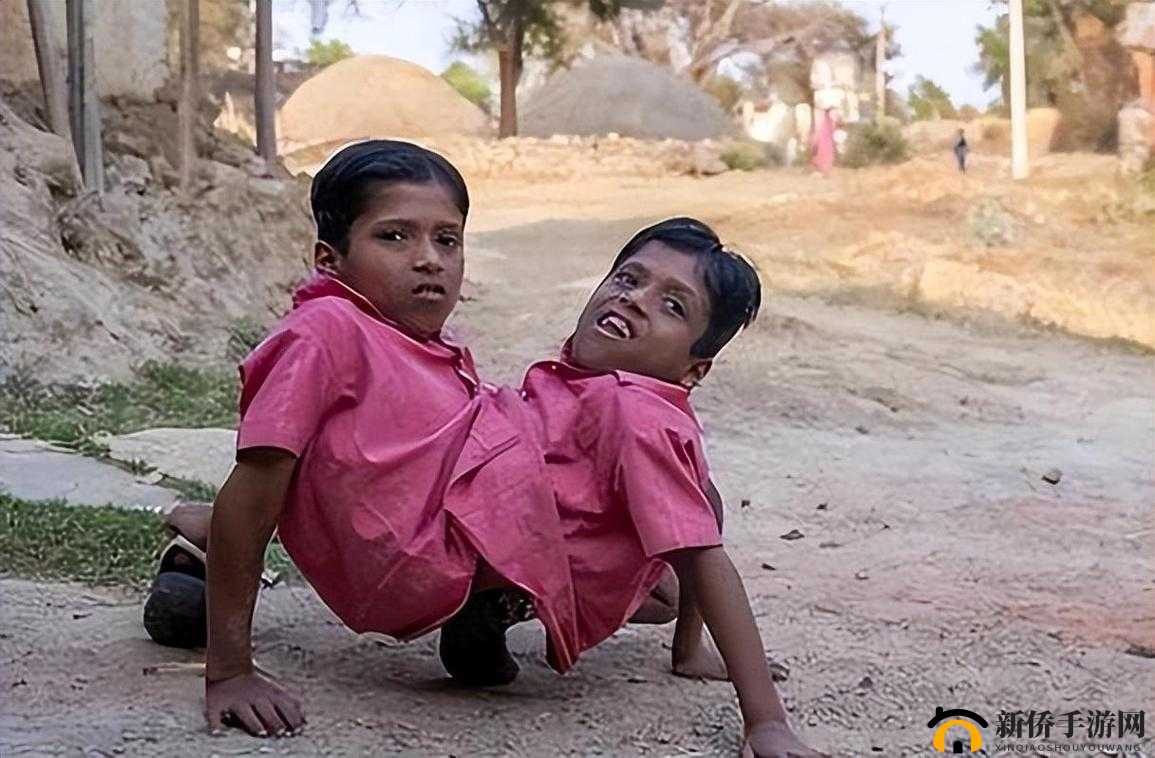 共生双胞胎：独特生命现象探秘