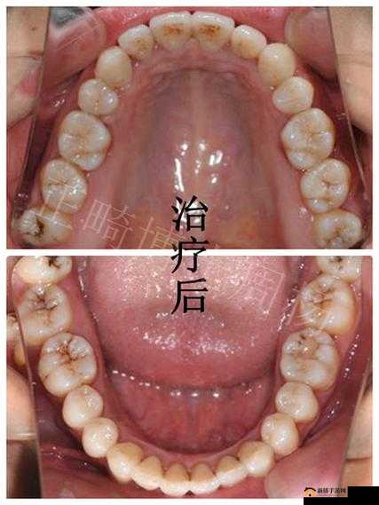 鑽鏁1v2hpo 姹熸季娌荤枟瑙ｆ瀽之我见