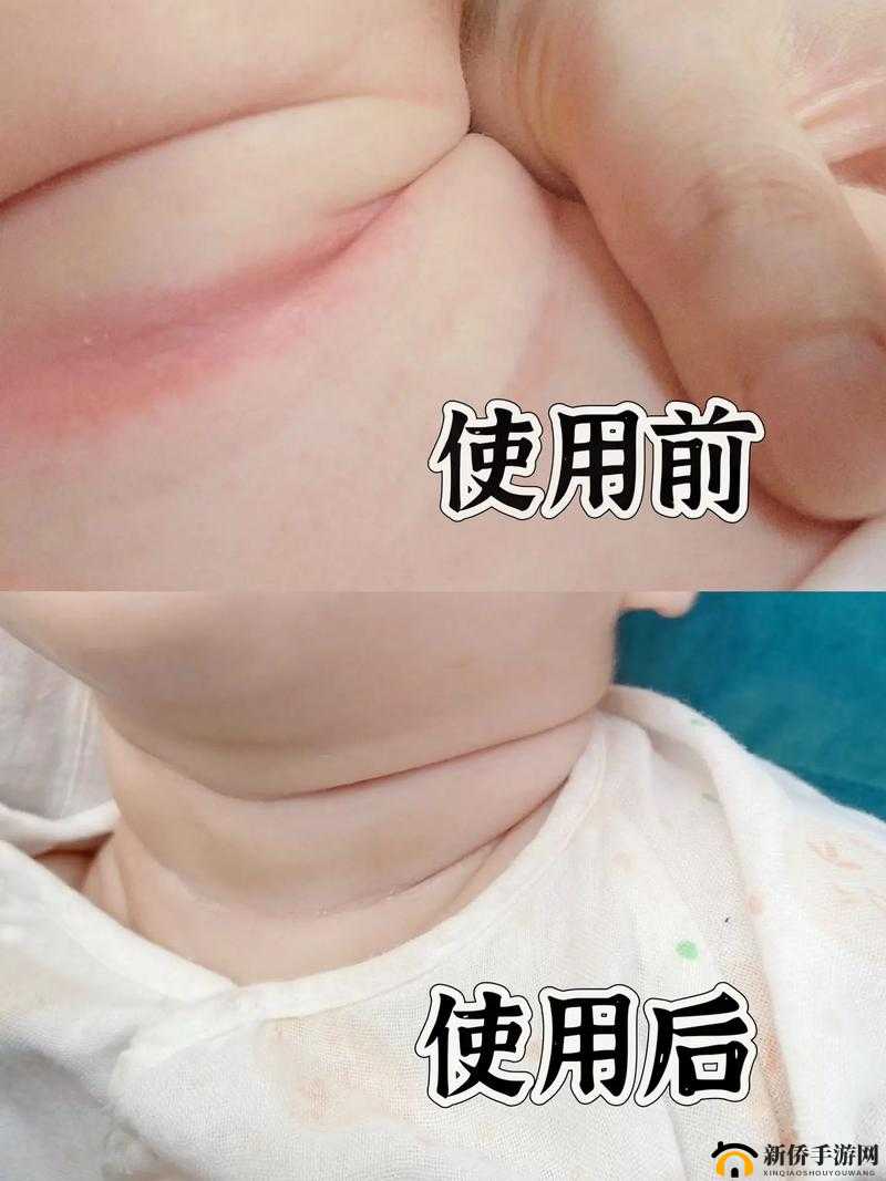 宝宝湿透嘴硬疼咋回事：原因探究