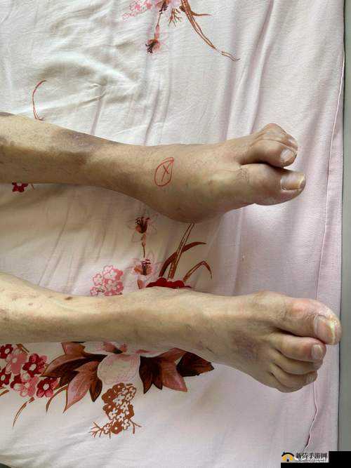 被黑人扒开双腿猛进夏科骨科：医学奇观还是道德争议？