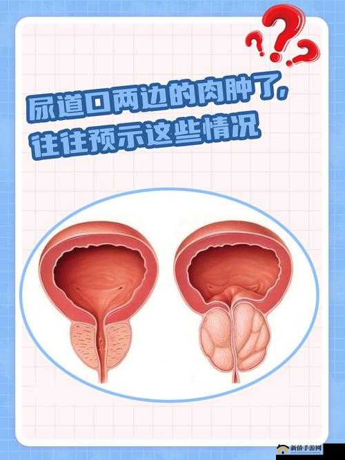 尿道口两边的肉肿了的原因：探究可能的致病因素