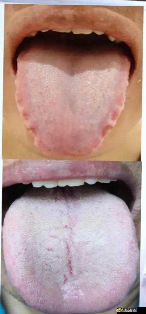 如何应对舌头探洞水好多的情况：有效的应对策略与技巧