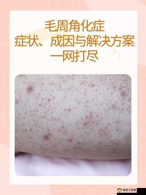 国色天香综合征：揭秘这种罕见病症的症状、成因及治疗方法